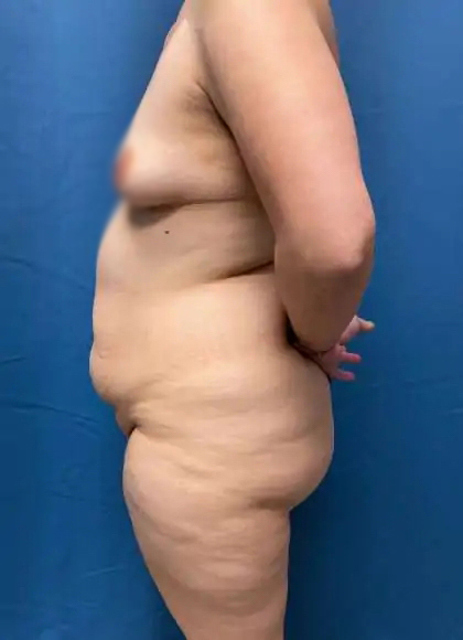 Lower Body Lift Before & After Patient #1008