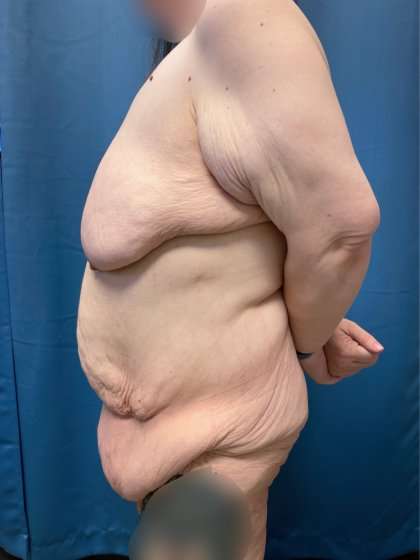 Lower Body Lift Before & After Patient #1021
