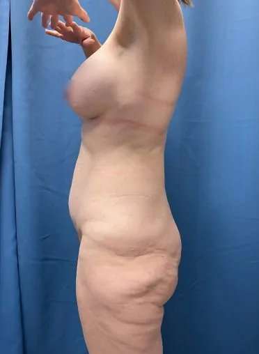 Lower Body Lift Before & After Patient #1034