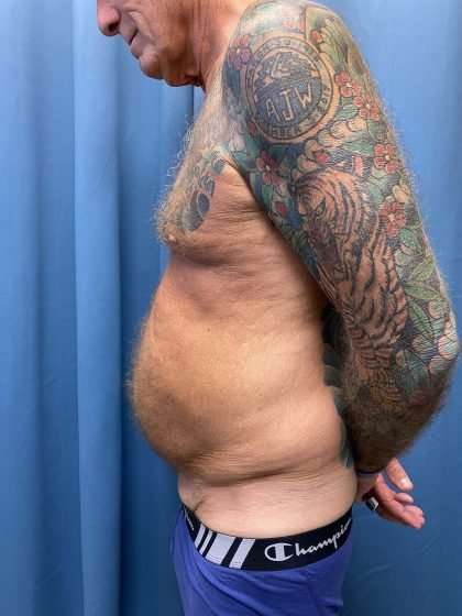 Tummy Tuck Before & After Patient #322