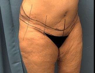 Lower Body Lift Before & After Patient #1047