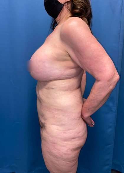 Lower Body Lift Before & After Patient #1063