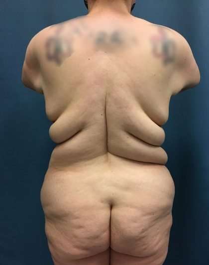 Lower Body Lift Before & After Patient #1072