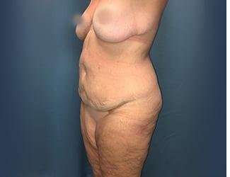 Lower Body Lift Before & After Patient #1101