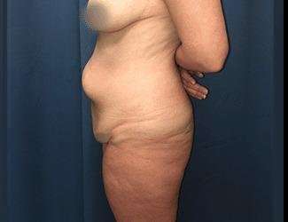 Lower Body Lift Before & After Patient #1114