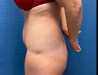 Lower Body Lift Before & After Patient #1127
