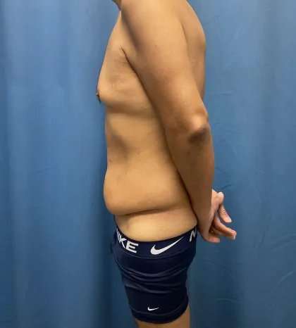 Tummy Tuck Before & After Patient #333