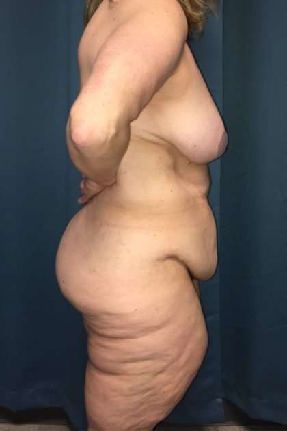 Lower Body Lift Before & After Patient #1174
