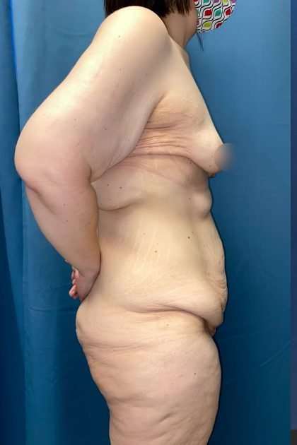 Lower Body Lift Before & After Patient #1187