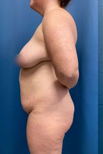 Lower Body Lift Before & After Patient #1200