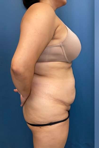 Lower Body Lift Before & After Patient #1213