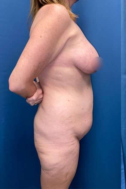 Lower Body Lift Before & After Patient #1239