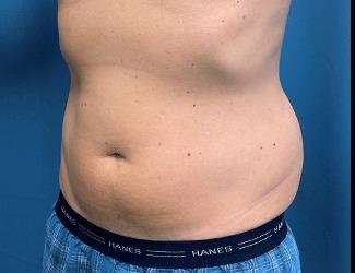 Liposuction Before & After Patient #1257
