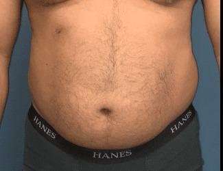 Liposuction Before & After Patient #1262