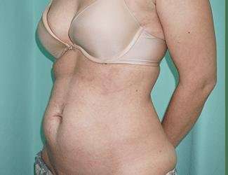 Tummy Tuck Before & After Patient #340
