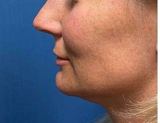 Lip Lift Before & After Patient #1289