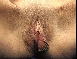Labiaplasty Before & After Patient #1319