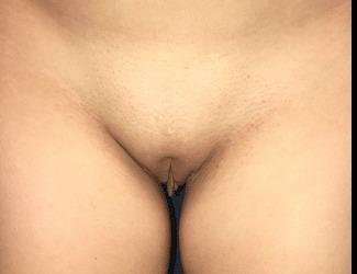 Labiaplasty Before & After Patient #1340