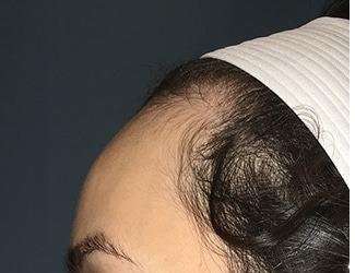 Forehead Reduction Before & After Patient #1364