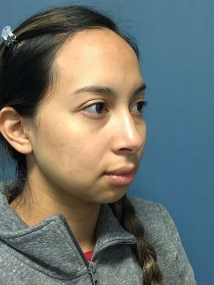 Forehead Reduction Before & After Patient #1371