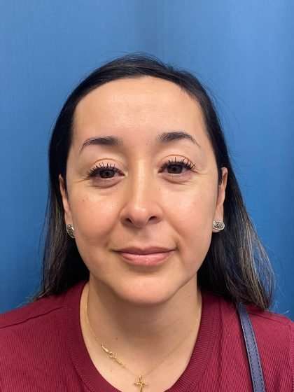 Forehead Reduction Before & After Patient #1376