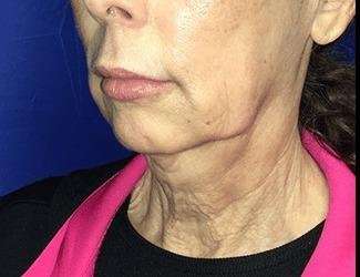 Facial Implants Before & After Patient #1392