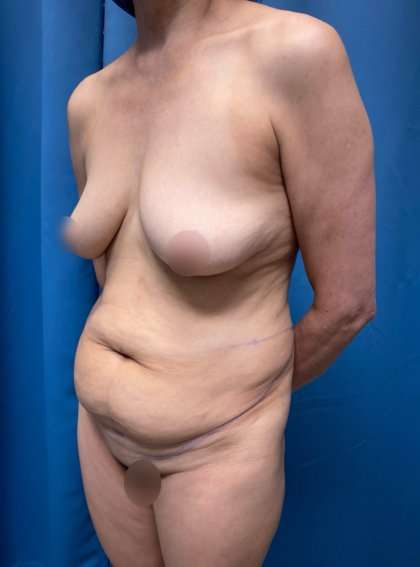 Tummy Tuck Before & After Patient #253