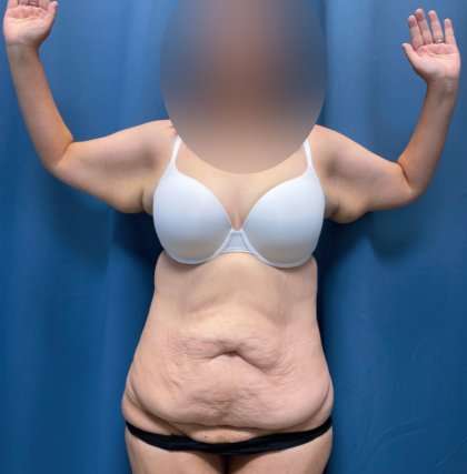 Tummy Tuck Before & After Patient #260