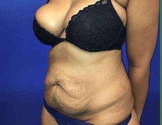 Tummy Tuck Before & After Patient #349