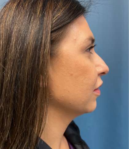 Facial Implants Before & After Patient #1486