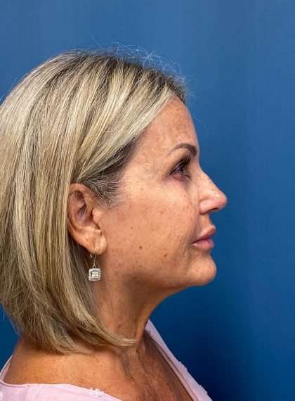 Facelift And Necklift Before & After Patient #1497