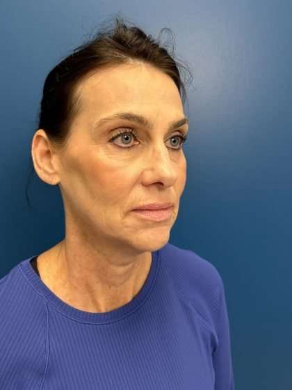 Facelift And Necklift Before & After Patient #1506