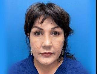 Facelift And Necklift Before & After Patient #1513