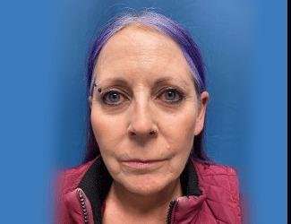Facelift And Necklift Before & After Patient #1520