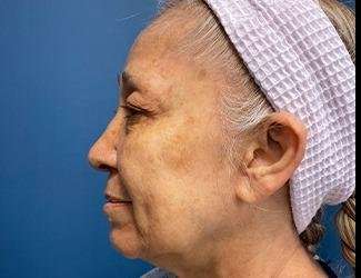 Facelift And Necklift Before & After Patient #1531