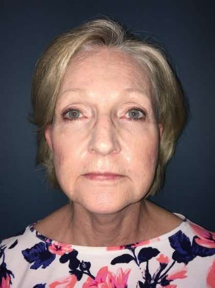 Facelift And Necklift Before & After Patient #1549