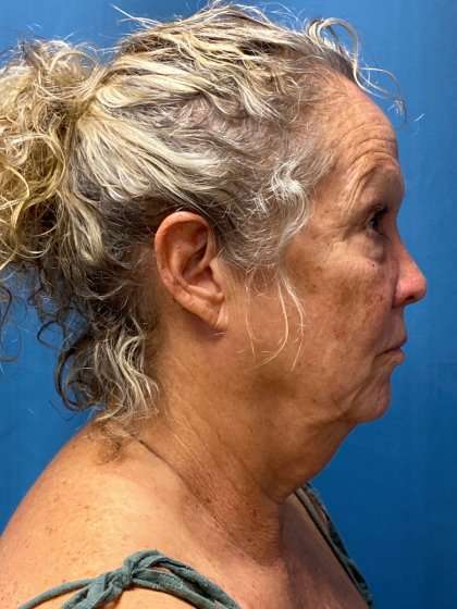 Facelift And Necklift Before & After Patient #1571
