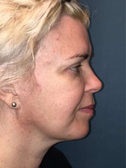 Facelift And Necklift Before & After Patient #1582