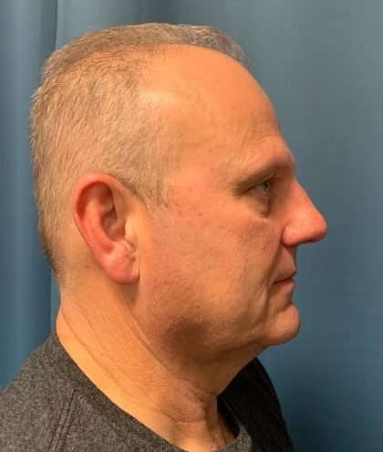 Facelift And Necklift Before & After Patient #1593