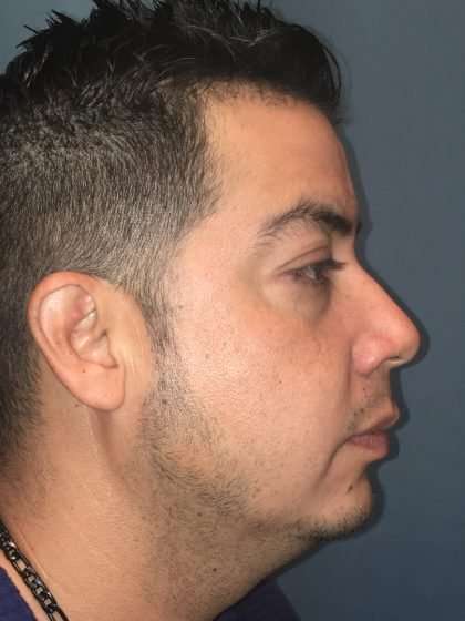 Chin Implant Before & After Patient #1604