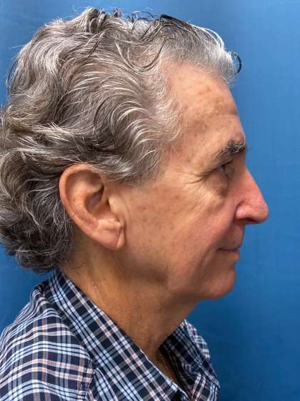 Chin Implant Before & After Patient #1633