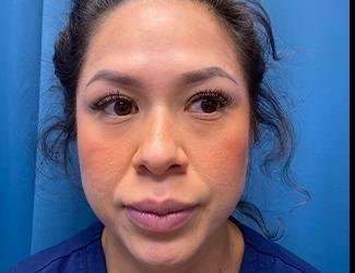 Buccal Fat Removal Before & After Patient #1643