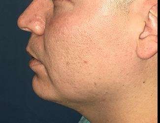 Buccal Fat Removal Before & After Patient #1656