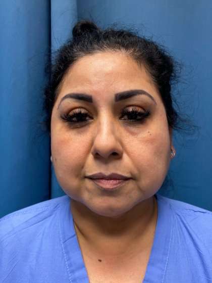 Buccal Fat Removal Before & After Patient #1663