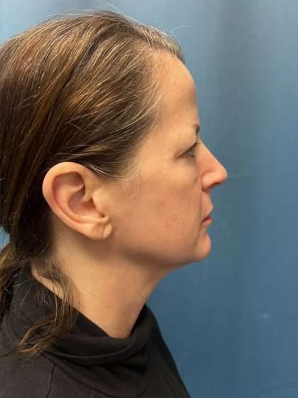 Brow Lift Before & After Patient #1674