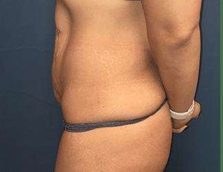 Tummy Tuck Before & After Patient #369