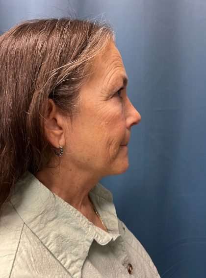 Brow Lift Before & After Patient #1685