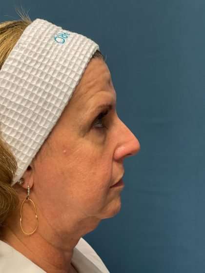 Brow Lift Before & After Patient #1694