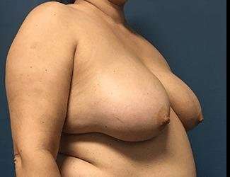 Breast Reduction Before & After Patient #1727