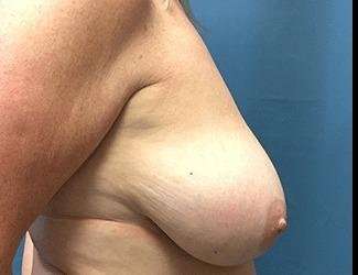 Breast Reduction Before & After Patient #1760